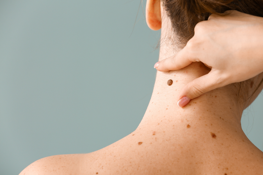 Blog Moles on the Body and Melanoma Skin Cancer_What's the Link