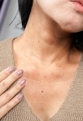 age spots on the neck