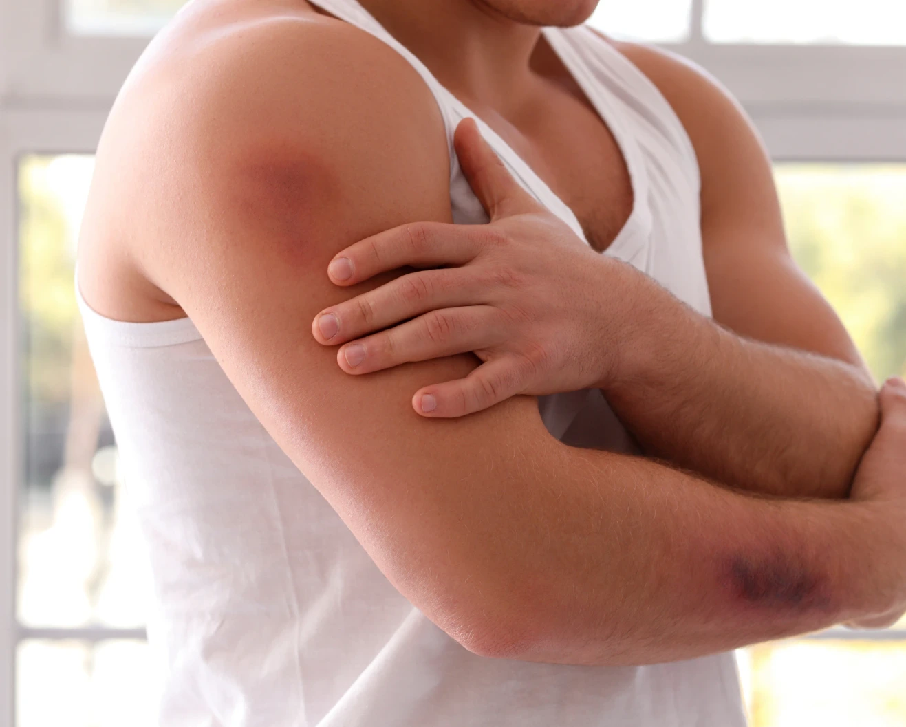 bruise on a man's upper arms