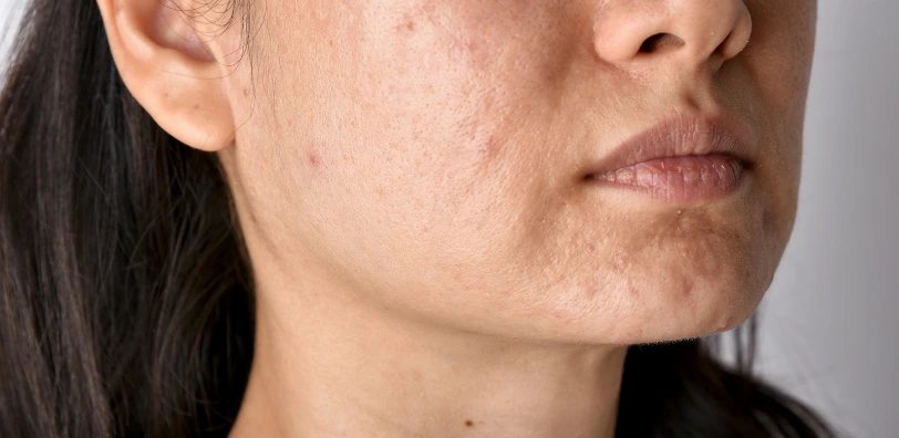 close up of acne scars and marks on skin