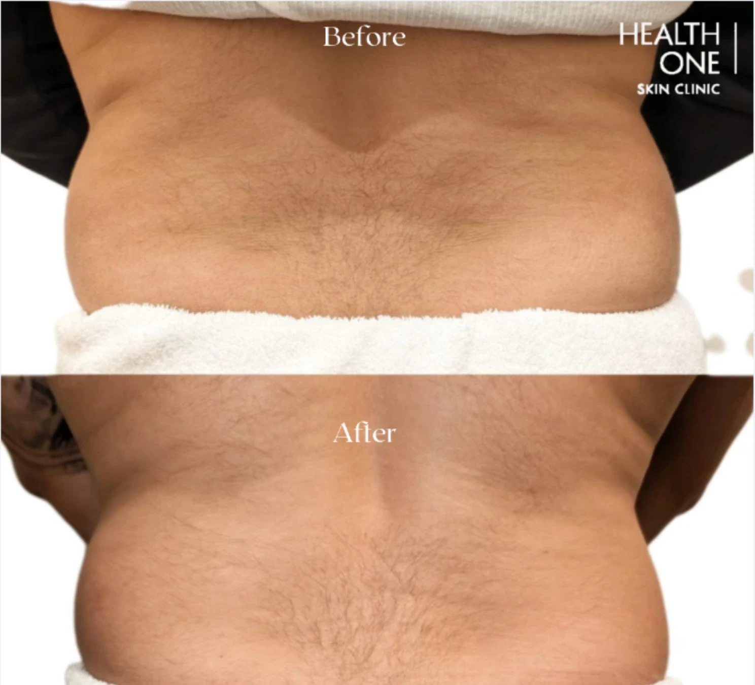 fat dissolving love handles before and after