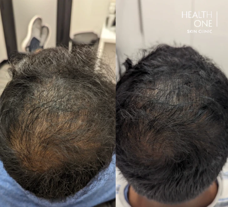 hair loss top of head before and after