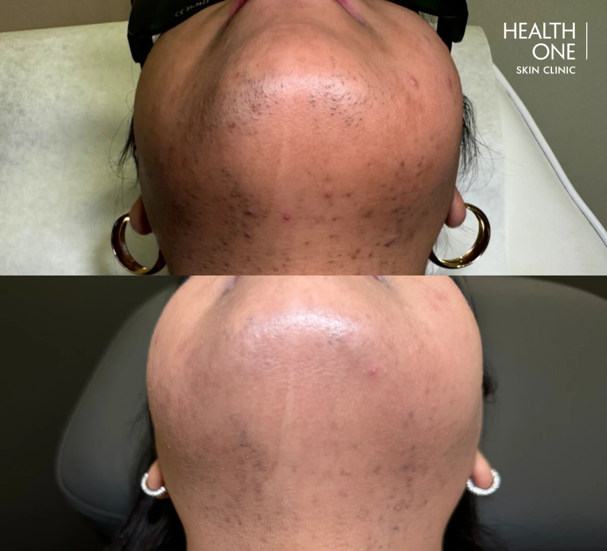 laser hair removal results before and after