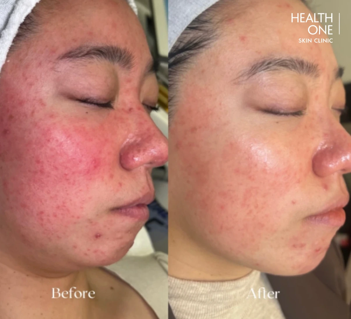 laser skin treatment results at skin clinic before after