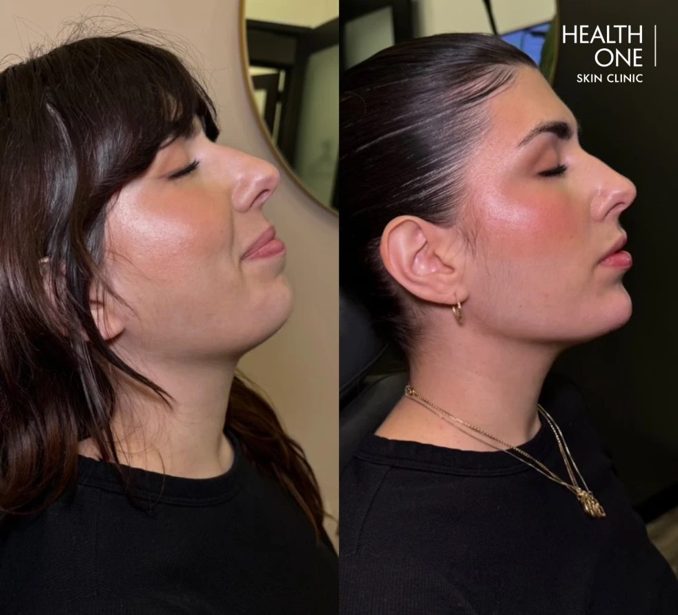 patient chin filler before and after results