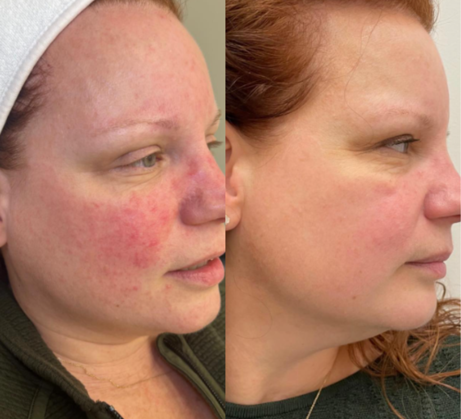 redness on woman's lower face skin