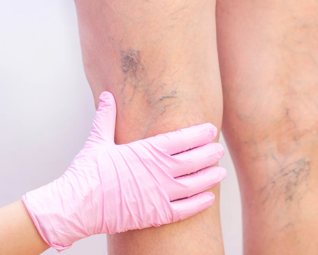 nurse assessing spider veins on the leg