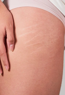 stretch marks on a woman's thigh