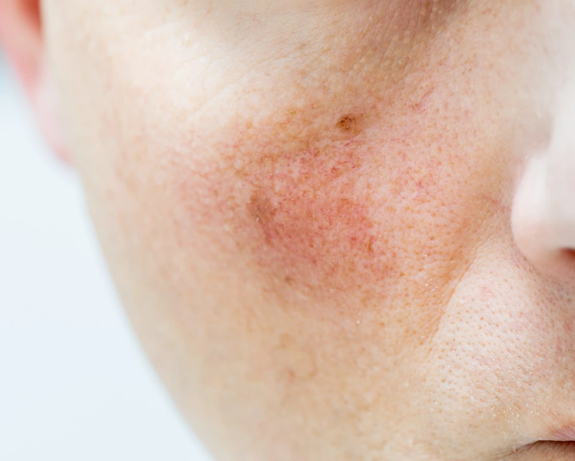 vascular lesion on the face