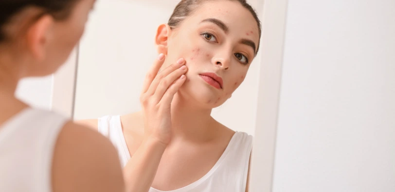 woman looking at acne scars in the mirror