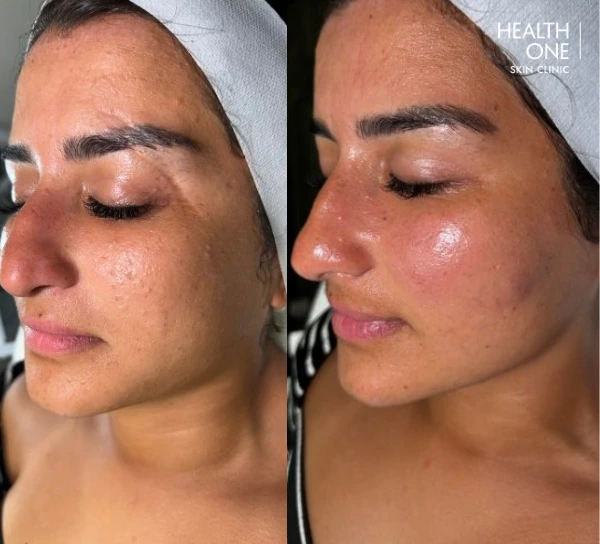 Acne+Detox+Facial