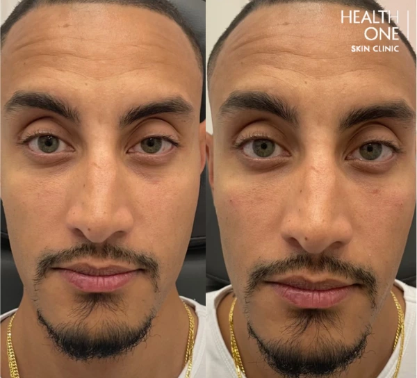 eyebrow+lift+treatment