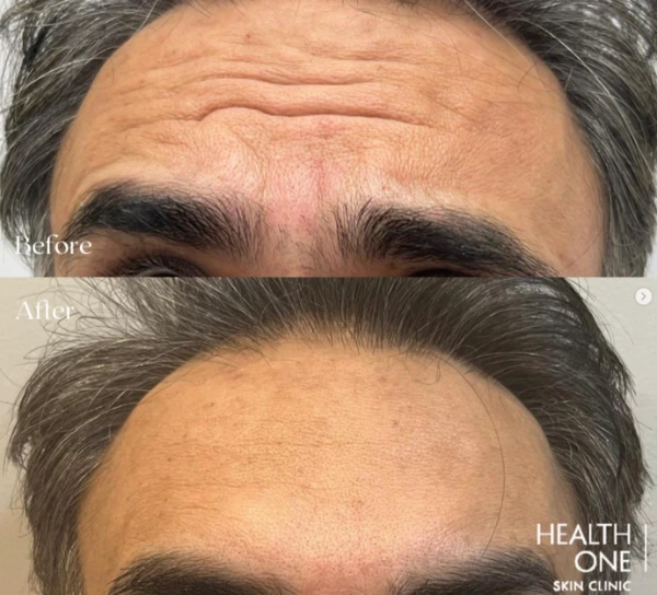 fine+lines+wrinkles+forehead+worry