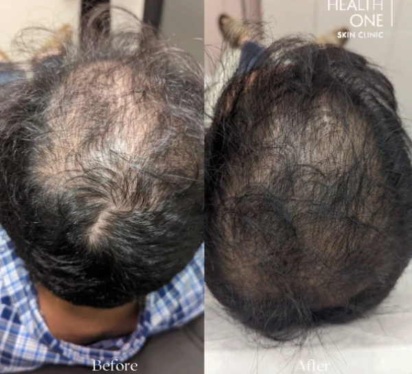 hair+before+after+prp