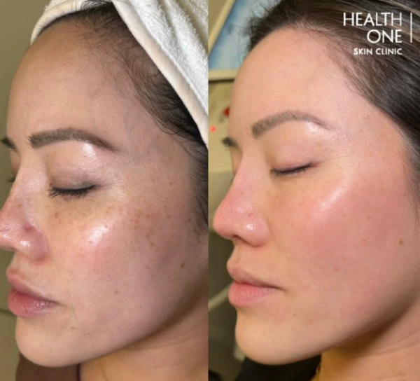 hyperpigmentation+before+and+after