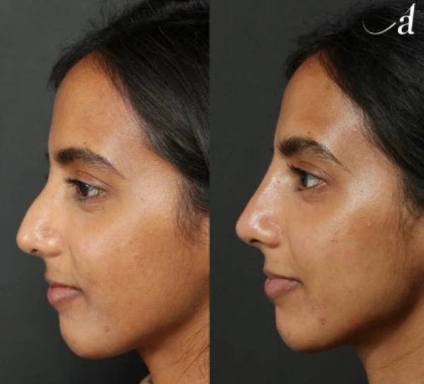 injectable+rhinoplasty+dr+ashlin+alexander