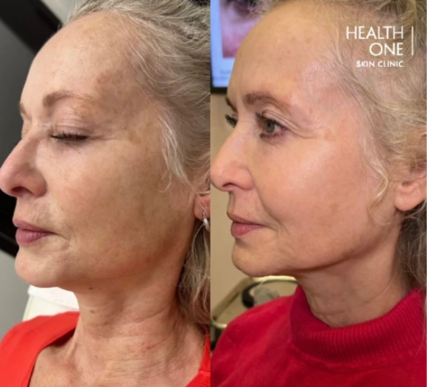 laser+skin+treatment+for+hypergimentation+and+antiageing