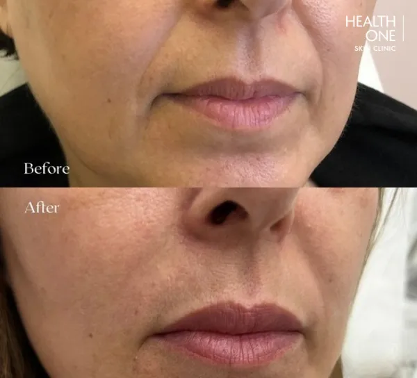 lines-around-the-mouth-nose