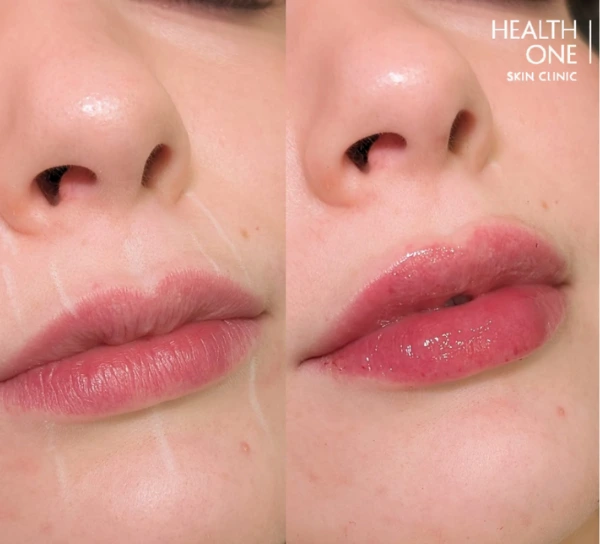 lip+fillers+before+after