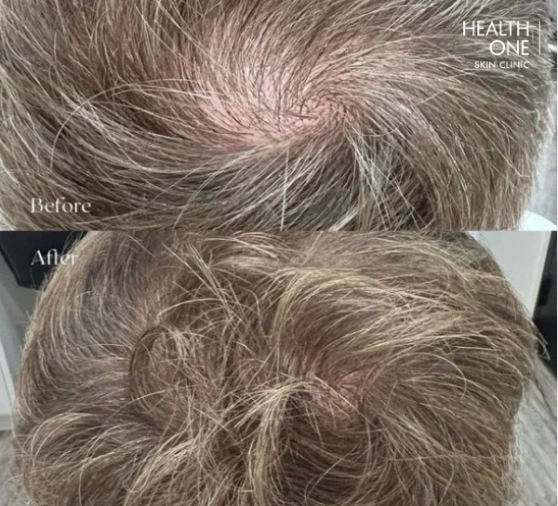 male+hair+loss+top+of+head