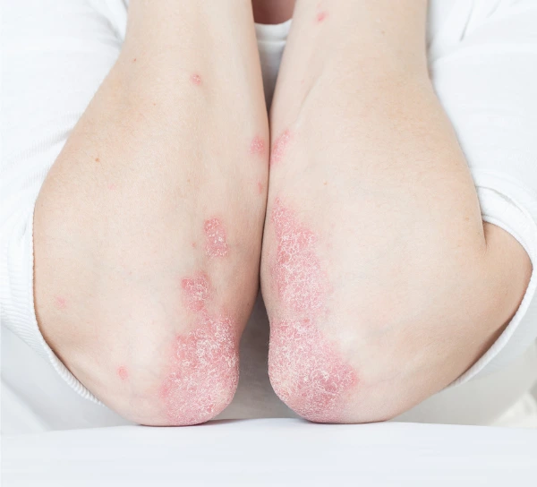 psoriasis+on+both+elbows