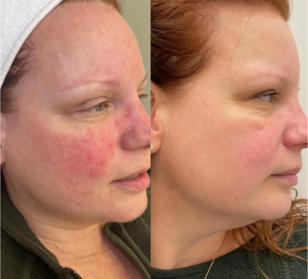 rosacea+before+and+after