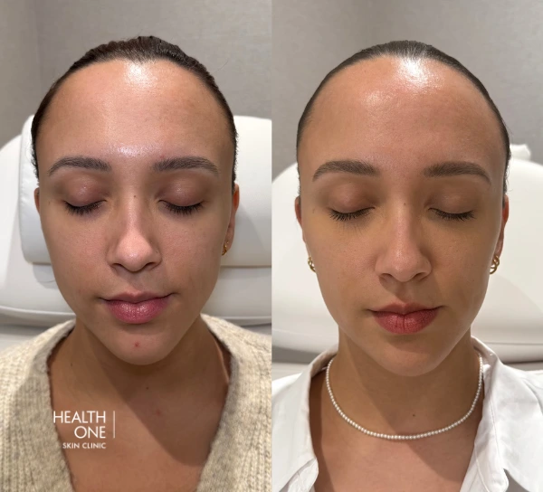 Patient who got Botox for muscle relaxing teeth grinding