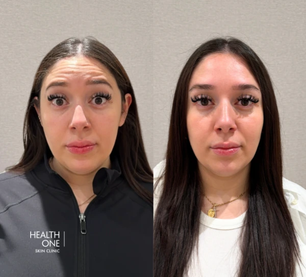 Happy Botox patient after +wrinkles+removed